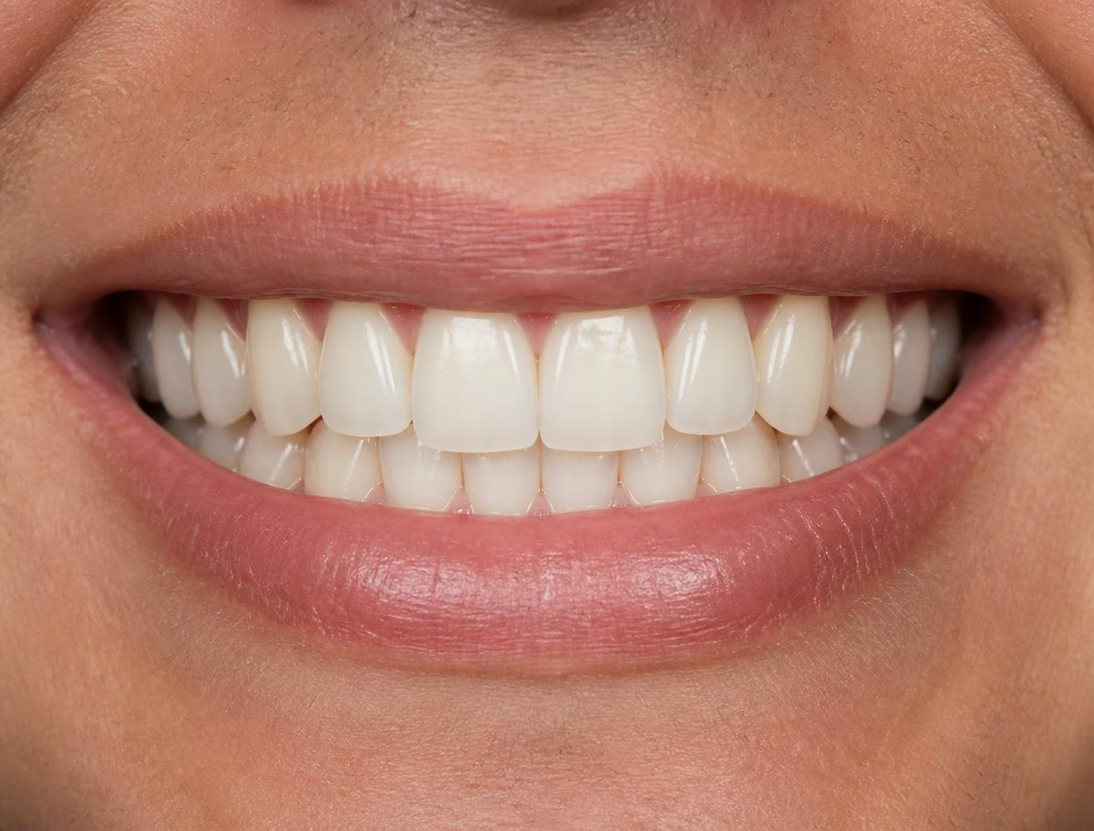 Illustrative example of a smile after dental treatment