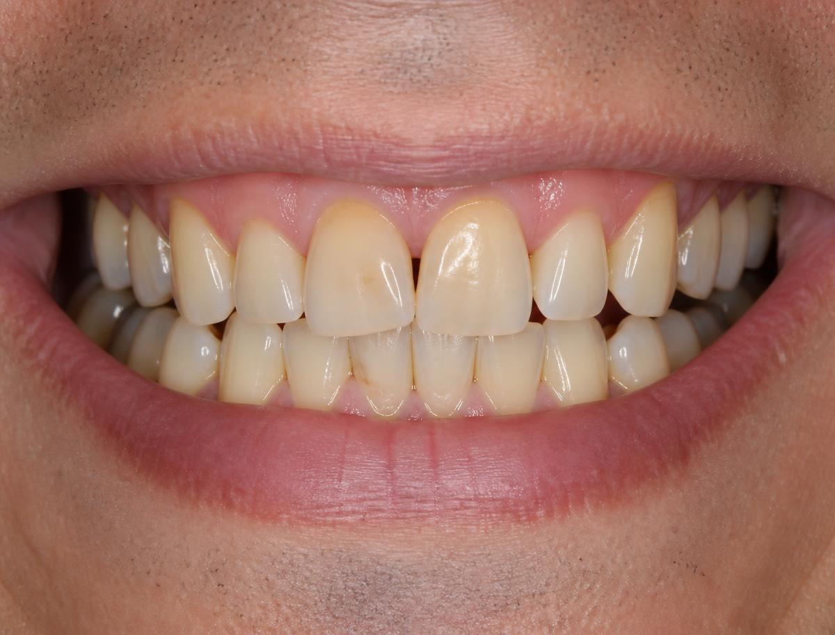 Illustrative example of a smile before dental treatment